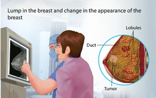 breast cancer device1 breast cancer device1